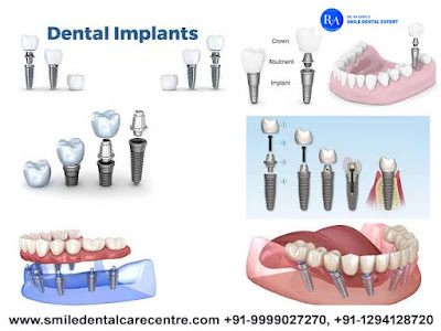 Best Dental Implant in Faridabad