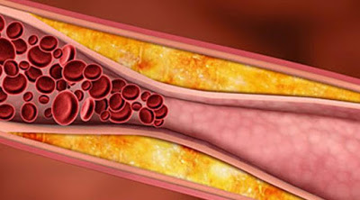 Yuk Hilang Kolesterol Jahat Dan Darah Tinggi Dalam 7 Hari dengan Konsumsi Resep Ini Sebelum Sarapan Dan Makan Malam