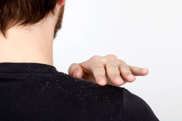 how to get rid of dandruff quickly