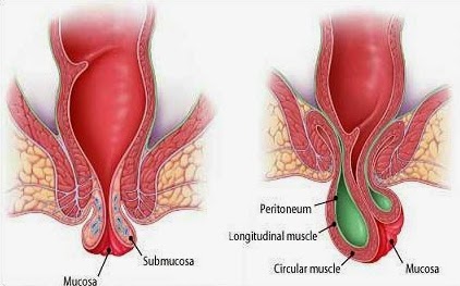 Obat wasir Herbal Untuk Ibu Hamil