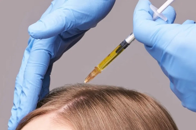 Il tricologo inietta PRP con una siringa nella testa di una ragazza di 33 anni nella nostra clinica di Tirana