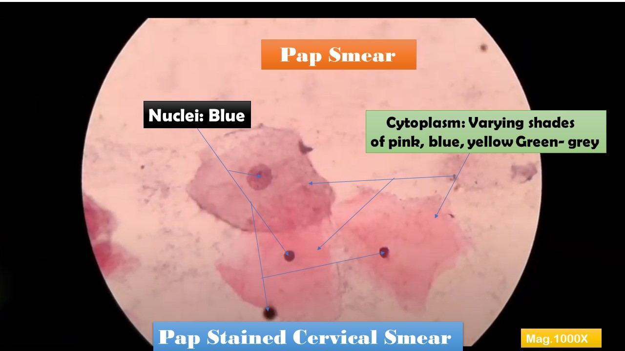 Pap Smear: Pemeriksaan Andalan untuk Deteksi Dini Kanker Serviks