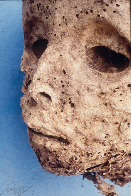 DNA analysis of 16th century mummy, thought to have smallpox, points to hepatitis B instead
