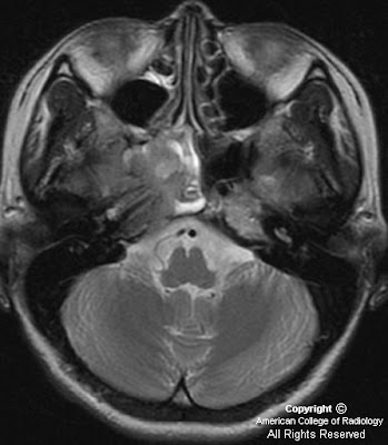 fossa of rosenmuller. Rosenmuller+fossa