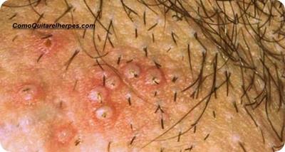 cura natural para el herpes, genital herpes, herpes, herpes genital,