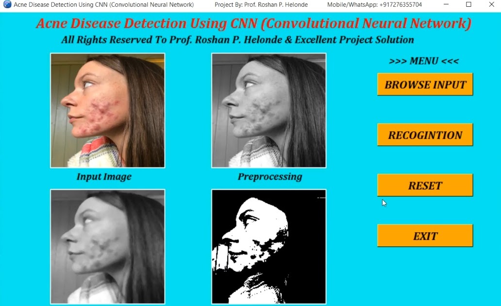 Acne Disease Detection Using Convolutional Neural Network CNN In Image ...