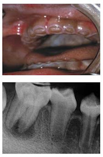 Dentinogenesis Imperfecta