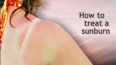 How to Treat a Sunburn - Skin Care Tips