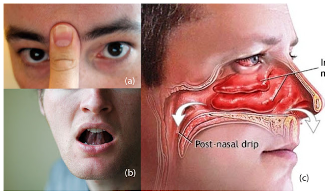 Cukup Butuh Waktu 30 Detik, Sinusitis Pilek Tersumbat Hilang Dengan Cara Mudah Ini, Share ke Yang Lain!!!