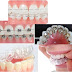 Ưu điểm của các loại mắc cài niềng răng