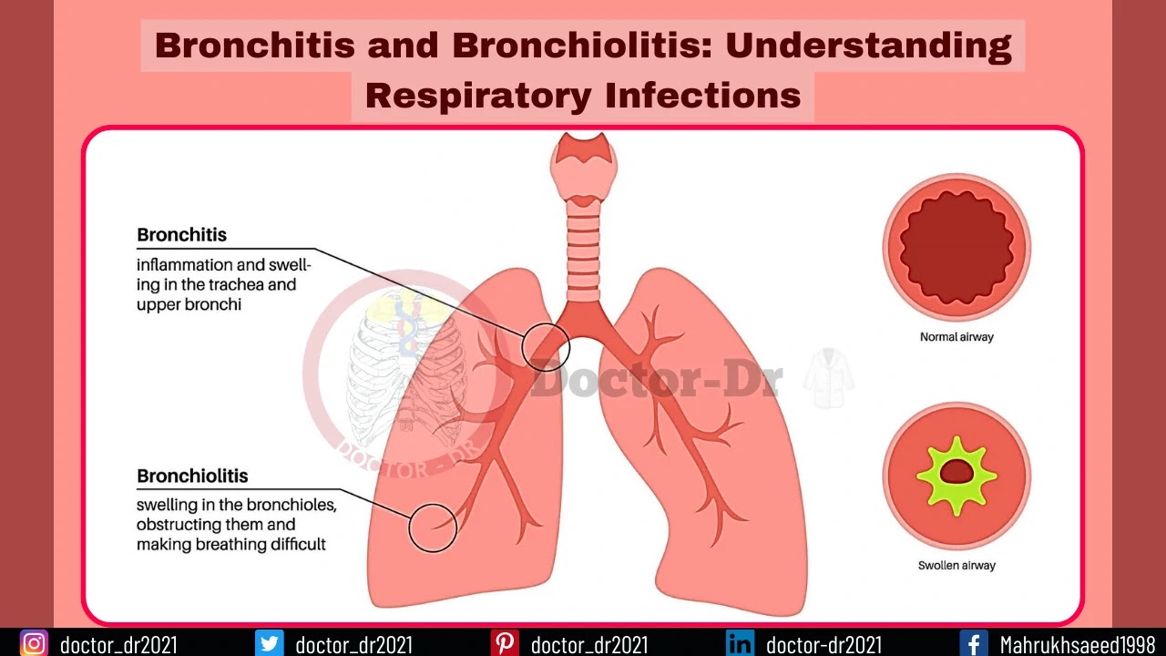 Bronchitis and Bronchiolitis: Understanding Respiratory Infections