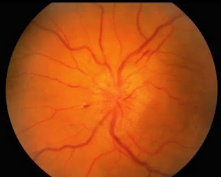 Short cases in ophthalmology