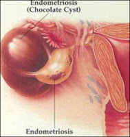 ATasi Kista Endometriosis dengan Zirzak ORAC