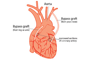 Angina Pectoris