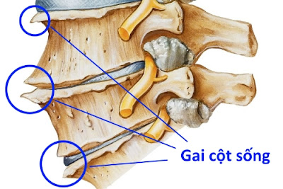 Điều trị gai đốt sống lưng bẩm sinh như thế nào ?