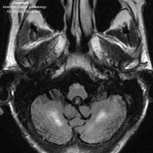 symmetric calcification in