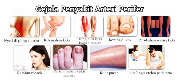 Cara Mengobati Penyakit Arteri Perifer Secara Tradisional