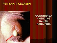 Penyakit Gonorrhea Gono