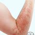 JENIS-JENIS EKZEMA: #2 CONTACT DERMATITIS