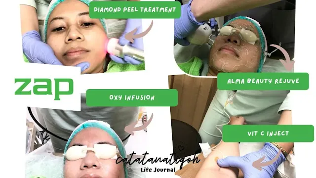 perawatan alma beauty rejuve zap