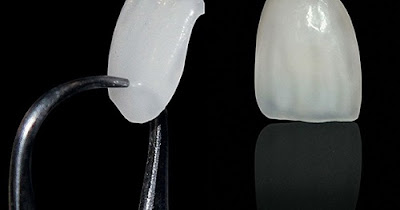 Có thể gắn lại răng sứ được không? 