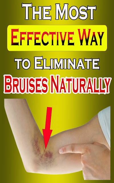 The Most Effective Way to Eliminate Bruises Naturally