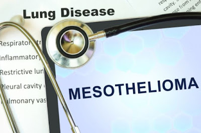 Frequently Asked Questions About Mesothelioma - Does Anyone Survive Mesothelioma