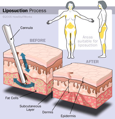 Zestzfulness: Apakah Sedut Lemak (liposuction 