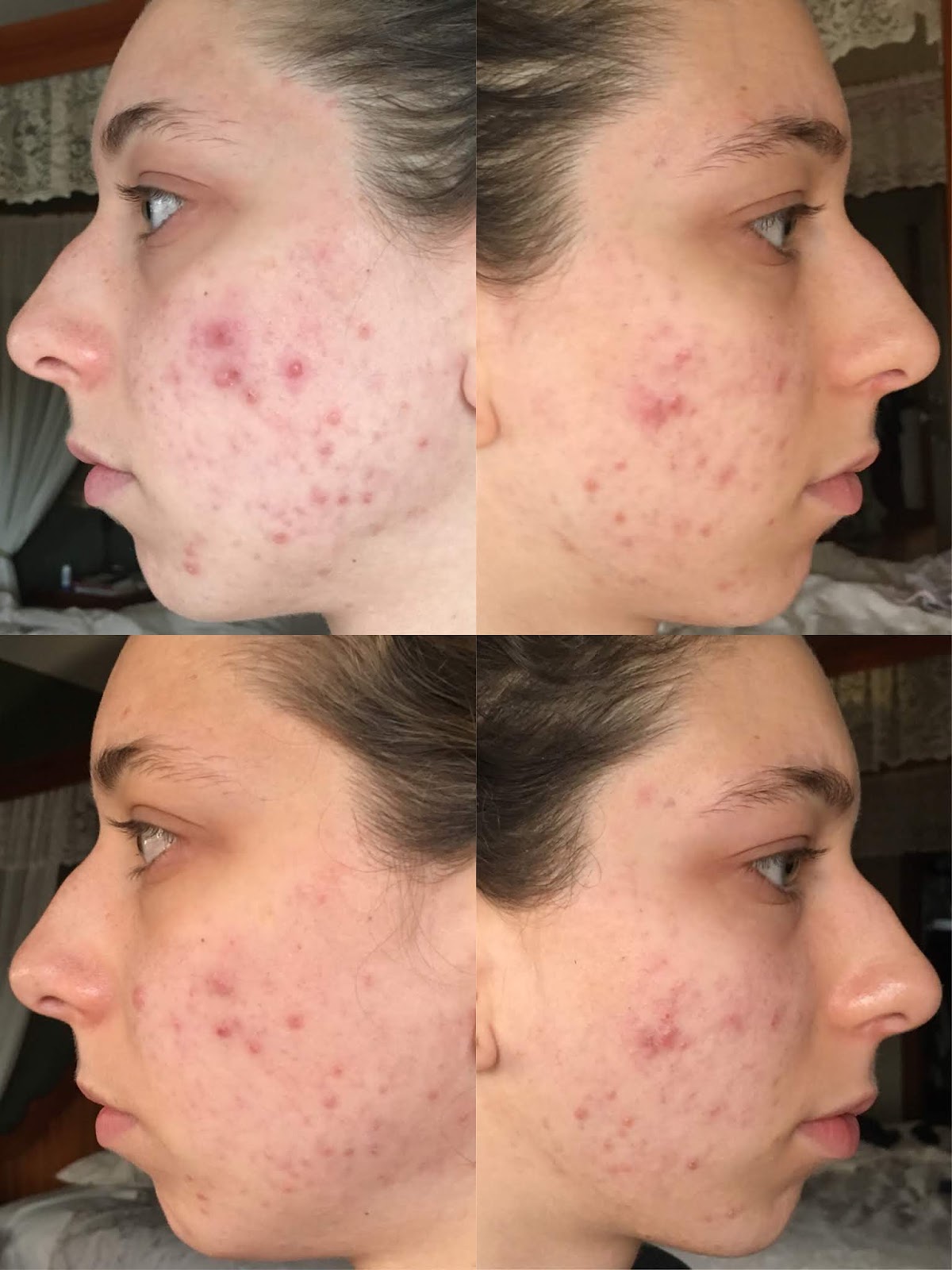 Can Aloe Vera Clear Hormonal Acne Scars In 1 Week The Daily Catchup