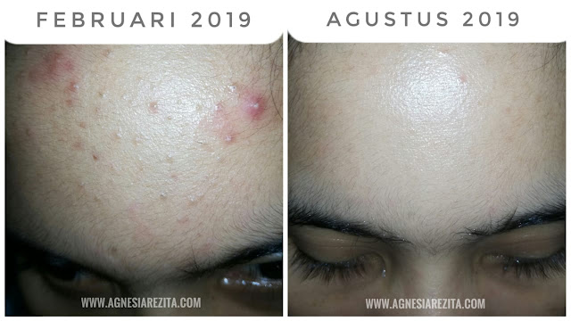 ACNE STORY – Update Pemakaian ElsheSkin Acne Series Selama 6 Bulan (Musnah Jerawat Semuka)