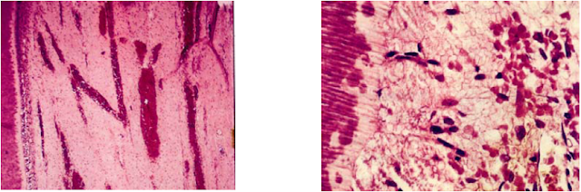 Hyperemia of the pulp in tooth undergoing orthodontic treatment