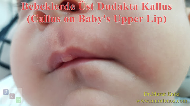 Üst dudakta kallus - Emzirme nasırları - Emme pedleri - Emme yastıkçıkları - Sucking callus - Sucking calluses - Sucking pads - Doğru emzirme - Correct latching - Bebeklerde üst dudak bağı belirtileri