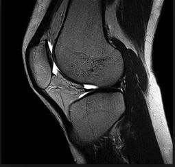 mr arthrogram