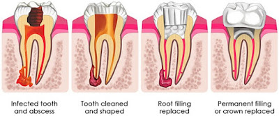 Root Canal Treatment Cost Melbourne