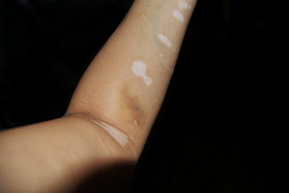 Que Es Bueno Para El Vitiligo