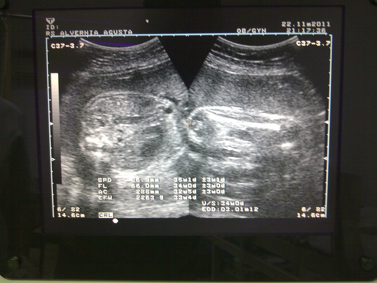 NathanaEL renantO: USG 2 Dimensi kehamilan 33 minggu