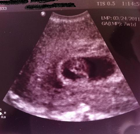 Life with Luca: My pregnancy in ultrasound