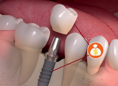 Thực hiện trồng răng sứ cố định có tốt không-2