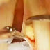 New Video on Vocal Cord Surgery Produced