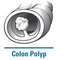 Colon Polyps