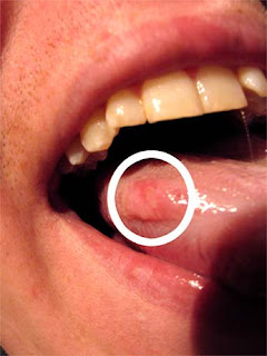 ulcer on tongue
