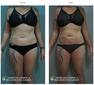 Liposuction in Mumbai