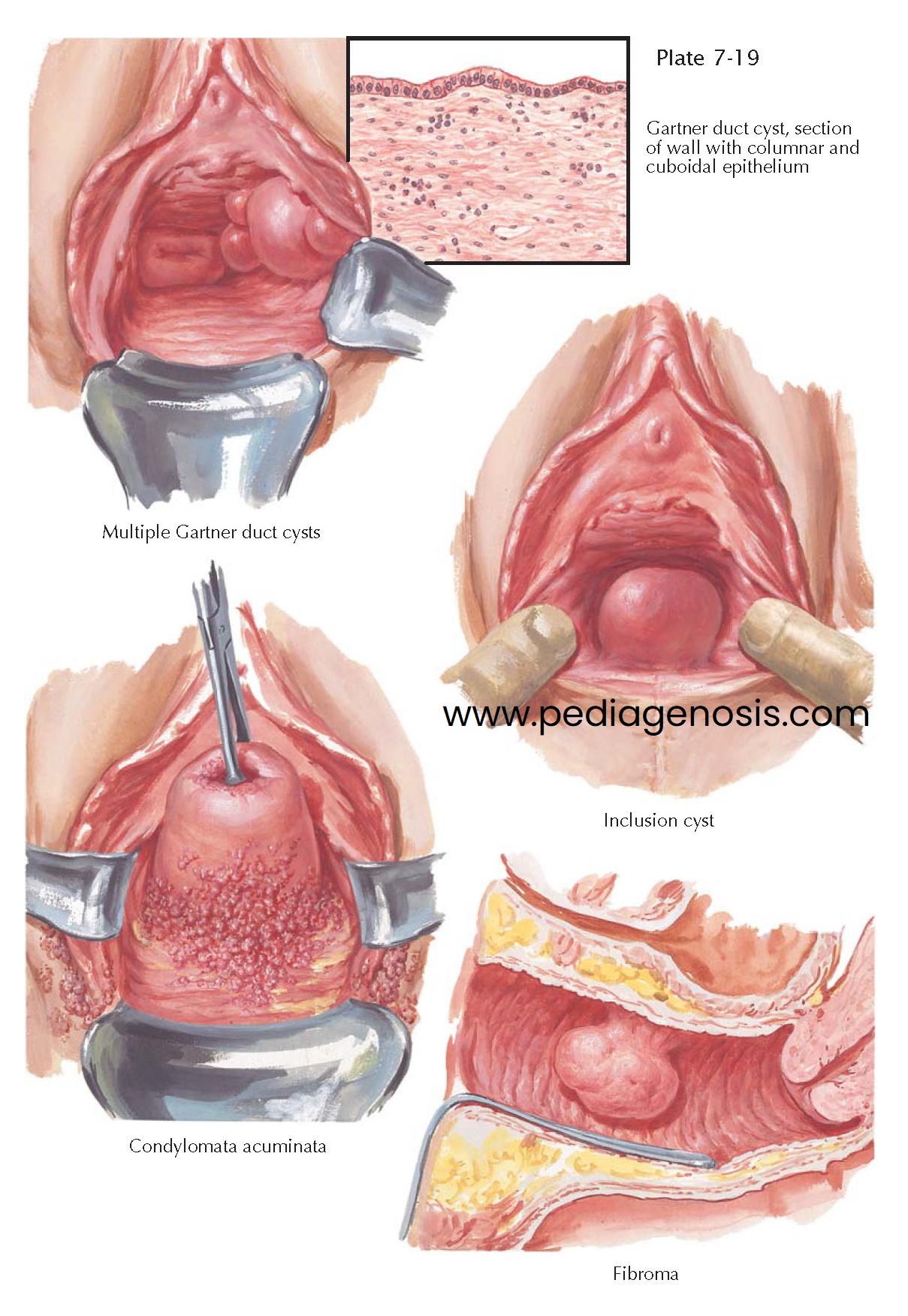 CYSTS AND BENIGN TUMORS