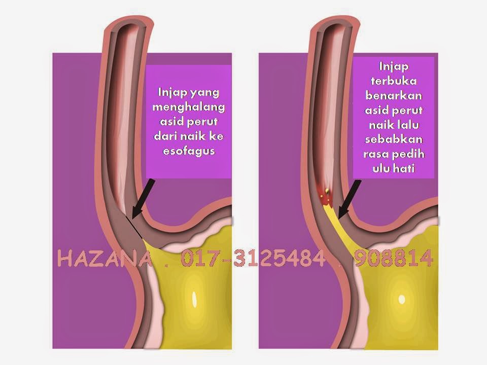 Makan Ubat Gastrik Ketika Hamil - Perum Anggrek