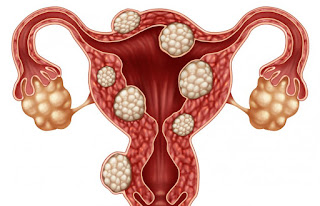 Cyst, Fibroids, Endometriosis dan Vivix Shaklee