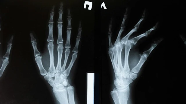 Detalle de los huesos de la mano en una radiografía, útil para detectar signos tempranos de debilitamiento óseo o pérdida de densidad
