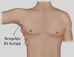 Cara Mengobati Benjolan Di Ketiak