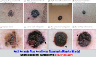 Gejala Penyebab Kutil Kelamin | Obat  Kutil Kelamin Kondiloma