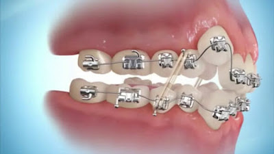 Hậu quả niềng răng sai cách bạn nên lường trước-1