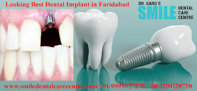 Dental Implants Treatment In Faridabad